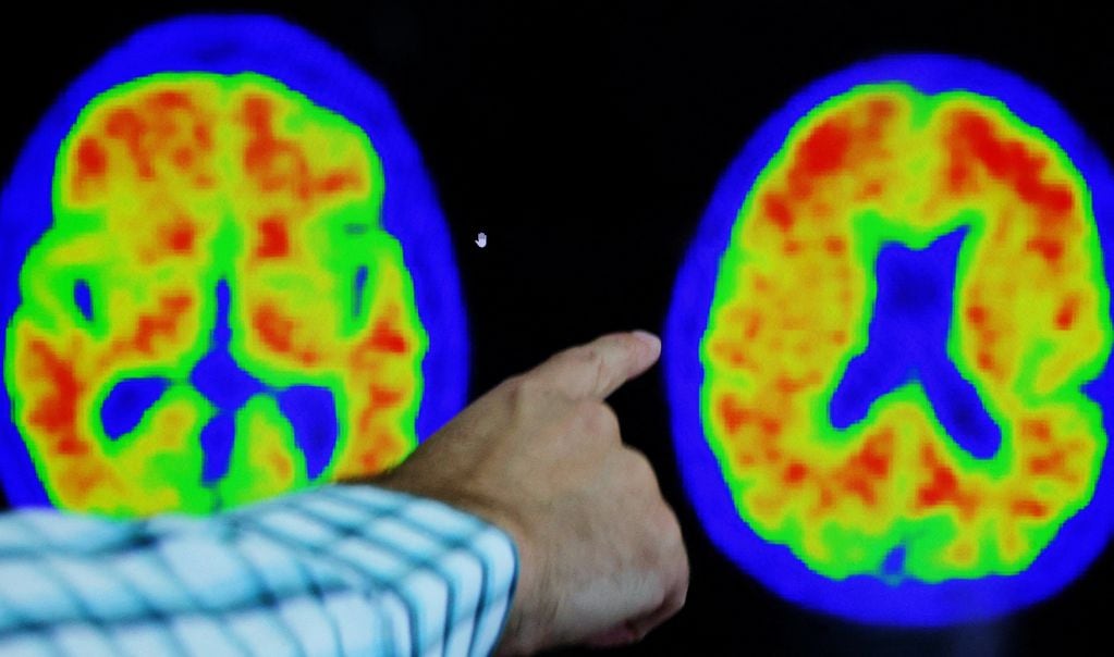 FILE PHOTO: Dr. Seth Gale points out evidence of Alzheimer?s disease on PET scans at the Center for Alzheimer Research and Treatment (CART) at Brigham And Women?s Hospital in Boston, Massachusetts, U.S., March 30, 2023. REUTERS/Brian Snyder/File Photo
