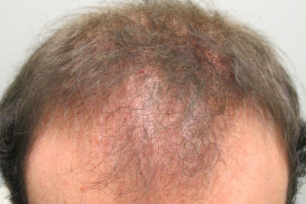 Alopecia Cicatricial