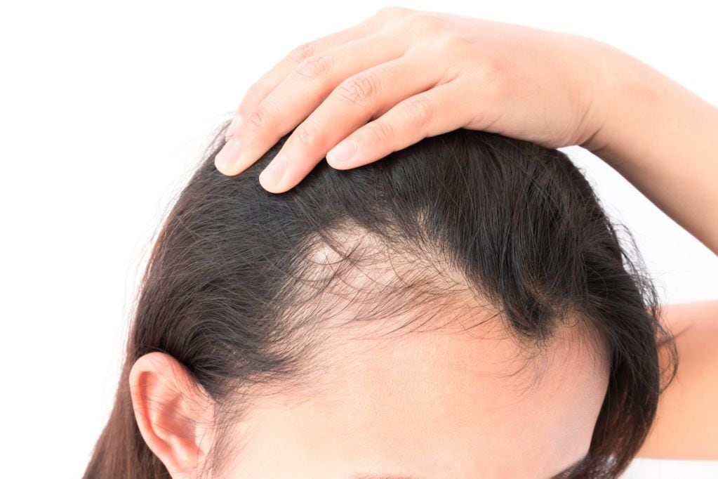 Aprueban fármaco contra la alopecia: obtuvo buenos resultados. Foto: Shutterstock.