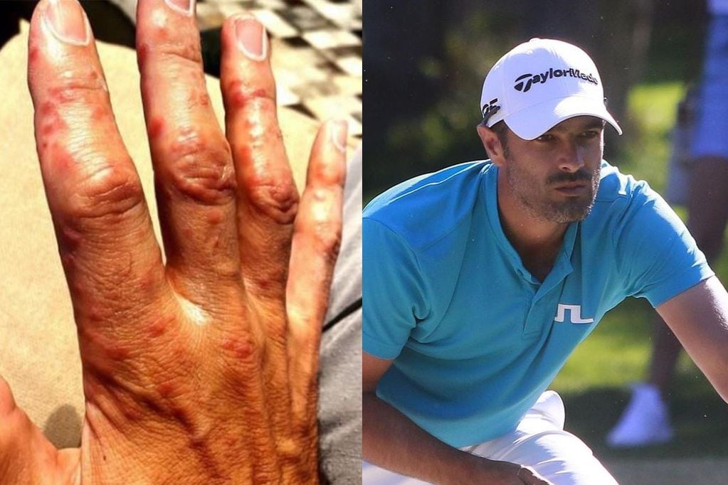 "Ataca las manos, los pies, la boca, pero lo peor de todo: el esófago”, dijo el golfista. Fotos: Instagram de Benjamín Alvarado.