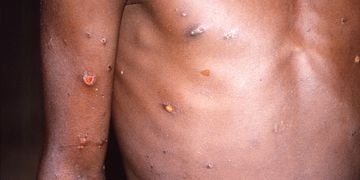 FILE PHOTO: A CDC image shows skin lesions on a monkeypox patient