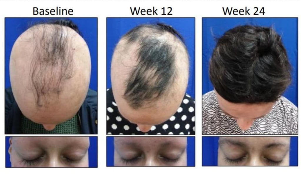 Pastilla contra la alopecia recuperaría el 80% del pelo.
