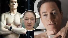 Magnate invirtió millones para rejuvenecer: tuvo brutal complicación con las inyecciones de grasa en el rostro