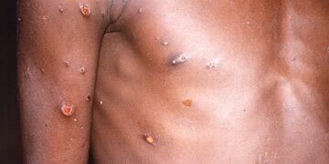 La viruela del mono produce lesiones cutáneas, fiebre y dolor corporal en las personas afectadas por el virus.