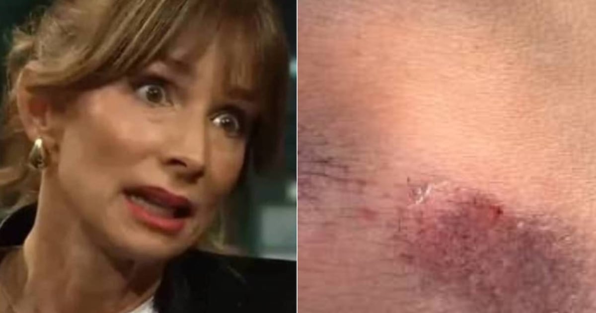 Actriz María José Prieto sufre doloroso accidente de tránsito en scooter