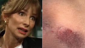 María José Prieto sufre doloroso accidente de tránsito e impacta al subir imágenes de sus heridas: explicó cómo ocurrió