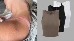 “Dolor insoportable”: Quemaduras por un top de Shein reavivan dudas sobre la seguridad de sus prendas