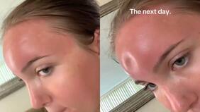 Joven se hace viral tras mostrar una fuerte quemadura de sol en su rostro