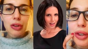 Así le quedaron los labios a Luz Valdivieso tras reacción alérgica luego de comer un tipo de queso