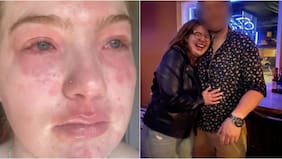 “Hay algo en él me hace tener esta reacción”: joven asegura que es “alérgica” a su pololo