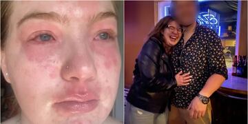 Joven asegura que es “alérgica” a su pololo (Foto: New York Post)