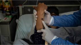 OMS decretó el fin de la emergencia internacional por la “viruela del mono”: incluyó advertencia