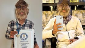 El rostro más peludo del mundo: Conoce la condición genética detrás del hombre record