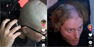 ¡Mucho cuidado! Streamers quedan con deformidades en sus cabezas por uso de pesados audífonos