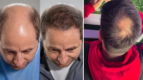 ¡Atención resbalín de piojos! Clínica regalará trasplante capilar para la mejor paya sobre la caída del cabello