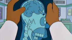 A lo Homero Simpson: Hombre sufría dolores de cabeza y descubrió que tenía palillos chinos en el cerebro