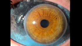 Influencer quedó ciega por semanas tras tatuarse los ojos