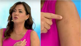 “Era del porte de un ojo”: Priscilla Vargas reveló que tuvo un tumor en el brazo