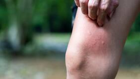 Aumento de picaduras en verano: Riesgos y recomendaciones de expertos