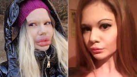 Influencer sorprende con impactante transformación: busca convertirse en la mujer con los labios más grandes del mundo