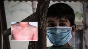 Cuentan la firme sobre el “brote” de fiebre escarlatina en Talca: colegio suspendió clases y encendió alarmas