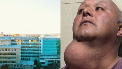 Tiene bulto en el cuello: Hospital Regional de Temuco tomó caso de carpintero que espera más de 15 años por operación